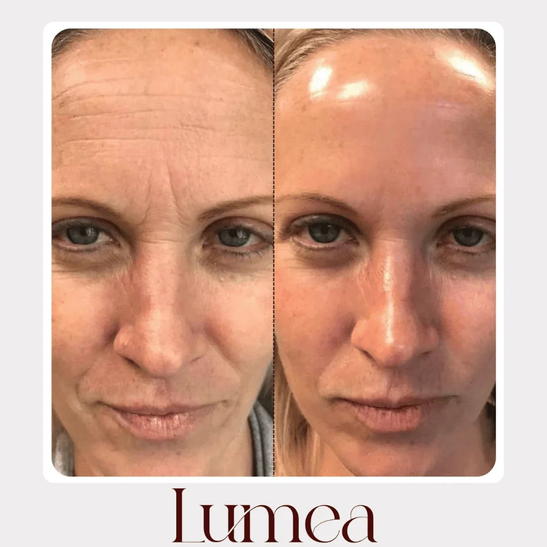 Lumea® – Rituale Viso Rinnovatore