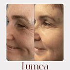 Lumea® – Rituale Viso Rinnovatore