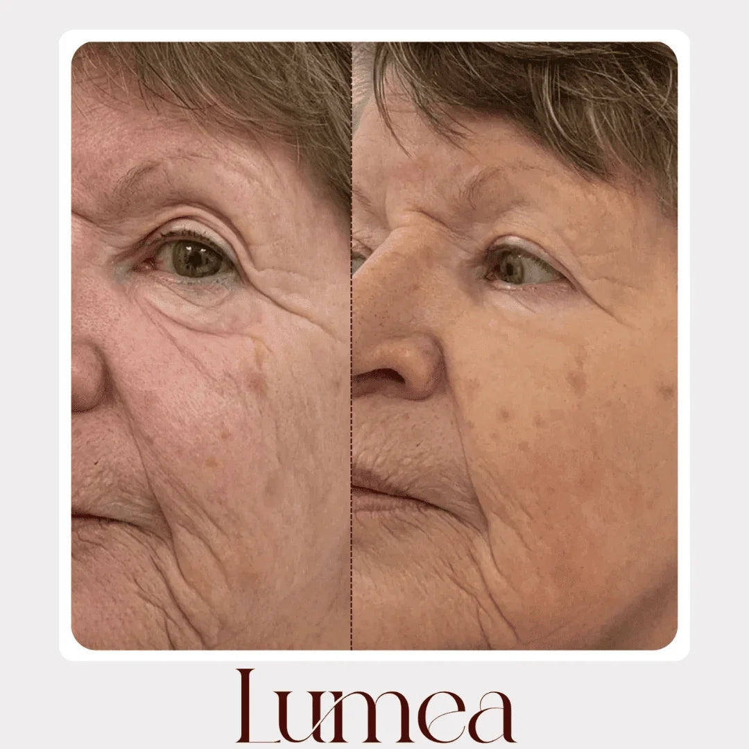 Lumea® – Rituale Viso Rinnovatore